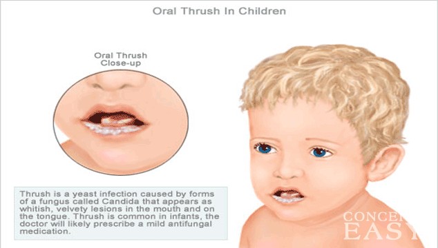 Yeast overgrowth neurological symptoms, pictures of thrush