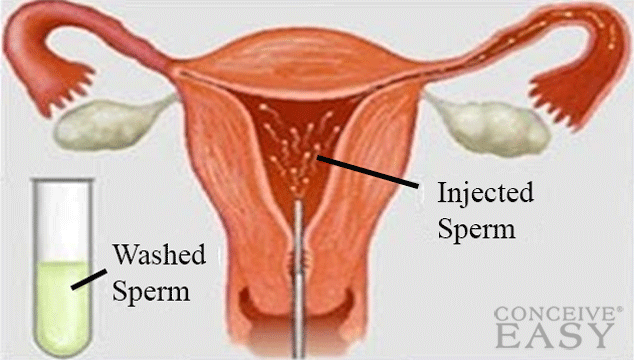 OPK and Intrauterine Insemination