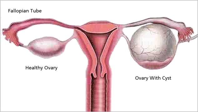 Is pregnancy possible with an ovarian cyst?