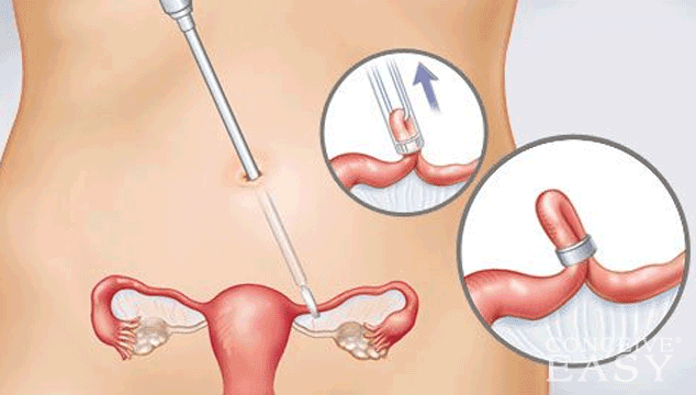 how-to-get-pregnant-after-you-tie-your-tubes how-to-get-pregnant-after-you-tie-your-tubes