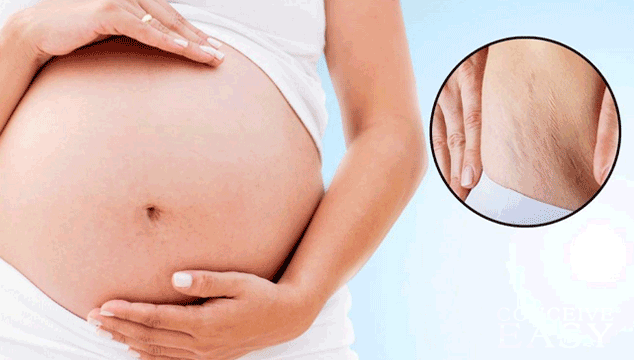 home-remedies-for-post-pregnancy-marks home-remedies-for-post-pregnancy-marks