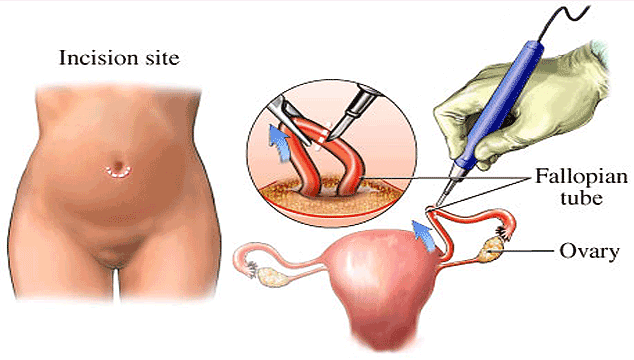 Getting Pregnant When Tubes Are Tied 95