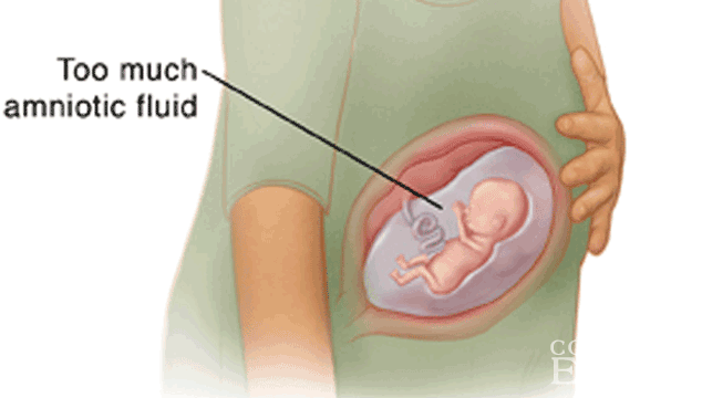 induced-labor-due-to-polyhydramnios induced-labor-due-to-polyhydramnios