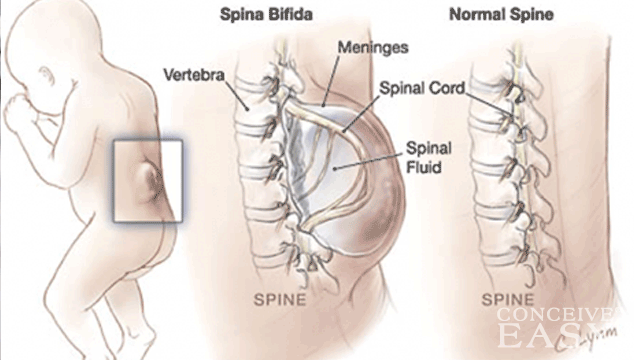 neural tube defect