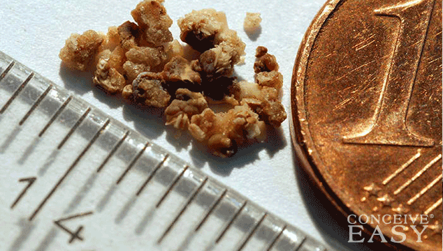 can-i-get-pregnant-with-kidney-stones can-i-get-pregnant-with-kidney-stones