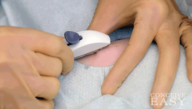 can-i-get-pregnant-with-the-nexplanon can-i-get-pregnant-with-the-nexplanon