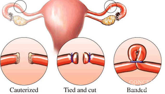 Can A Woman Get Pregnant With Her Tubes Tied 12