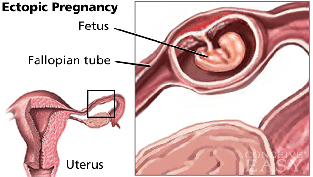 Ectopic (Tubal) Pregnancy Causes, Symptoms and Treatments ...