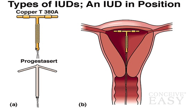 Can You Get Pregnant With Iud 74