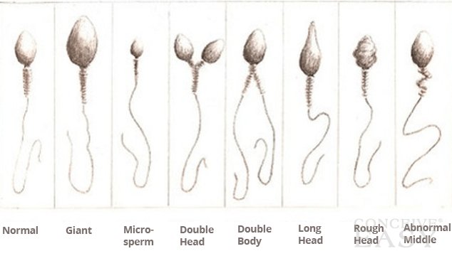 Conceiving thith abnormal sperm Conceiving thith abnormal sperm