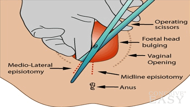 Episiotomy or Tearing? - ConceiveEasy