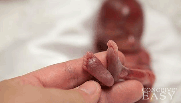 Signs of Miscarriage