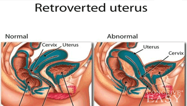Sexy Retroverted Uterus Getting Pregnant. 