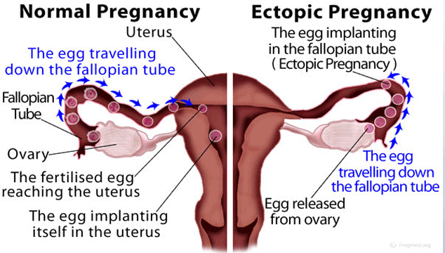 Ectopic Pregnancy vs Normal Pregnancy – ConceiveEasy.com