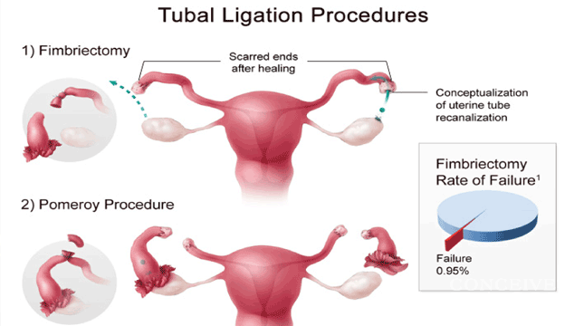 Can I Get Pregnant with Bilateral Tubal Ligation ...