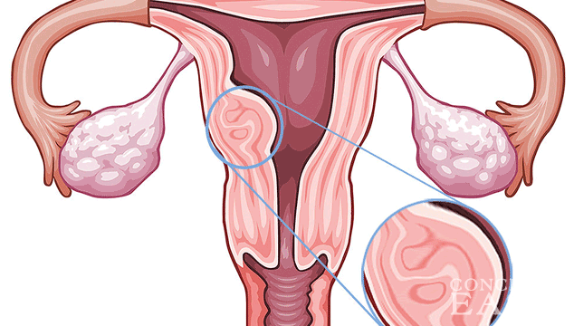Can I get Pregnant with Submucosal Fibroid? | ConceiveEasy.com